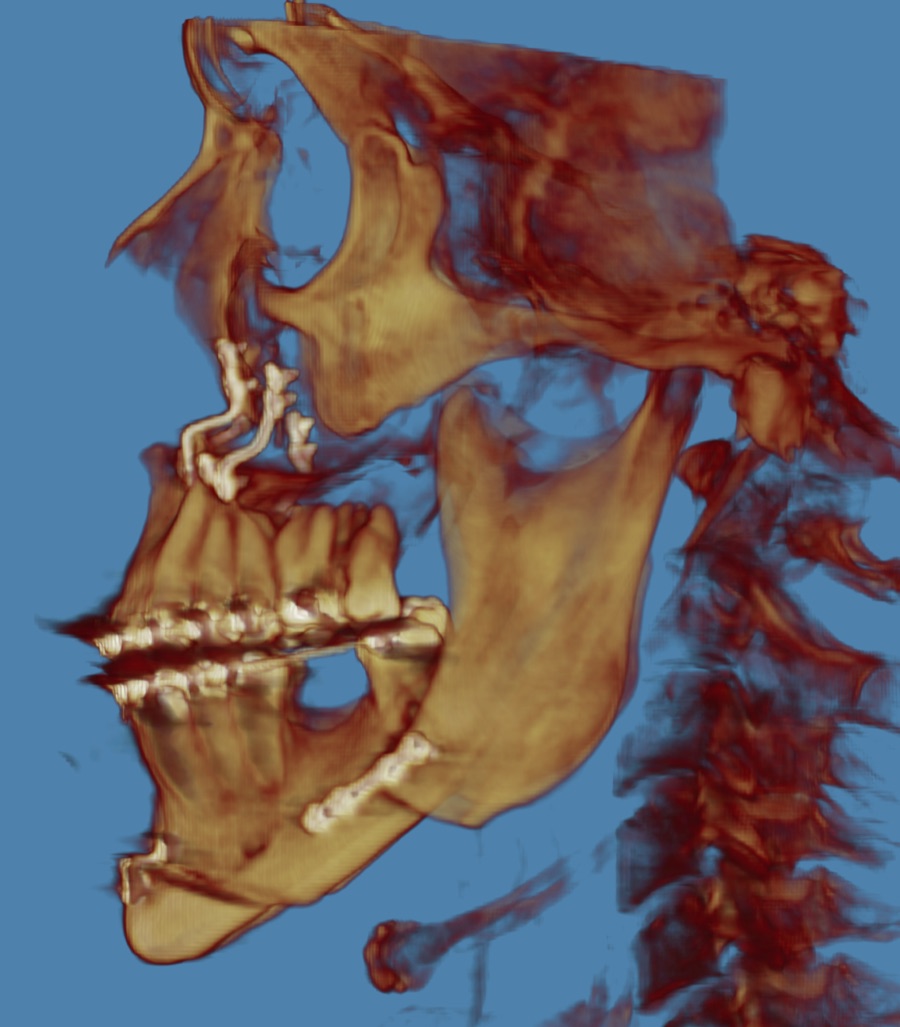 After orthognathic surgery