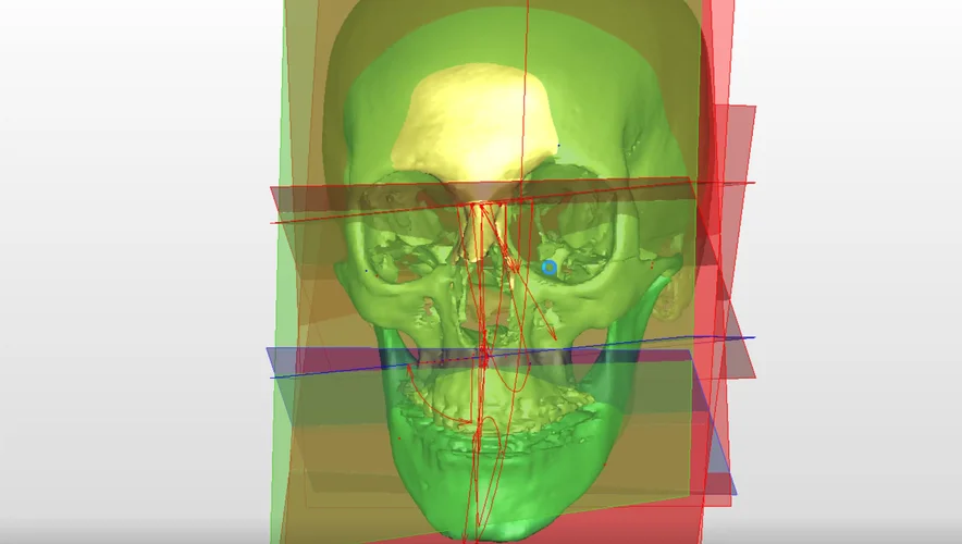 Planificación cefalométrica 3d