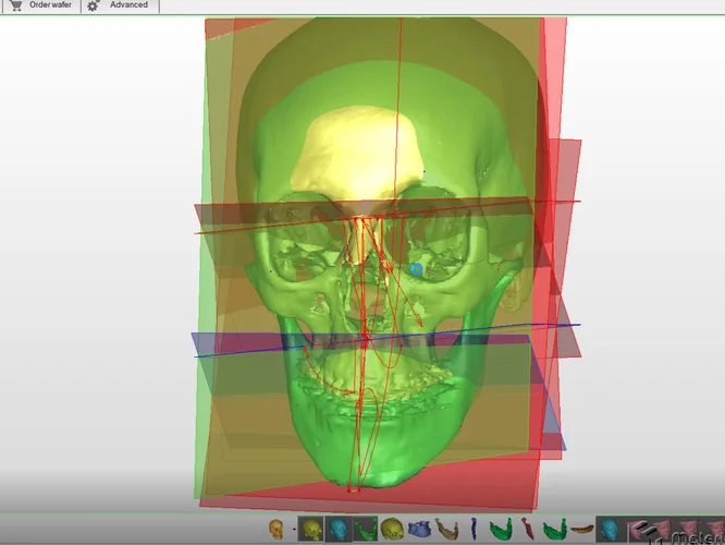Planificación cefalométrica 3d