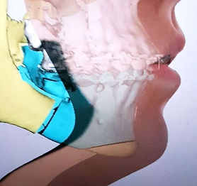Planificación 3d en cirugía ortognática.