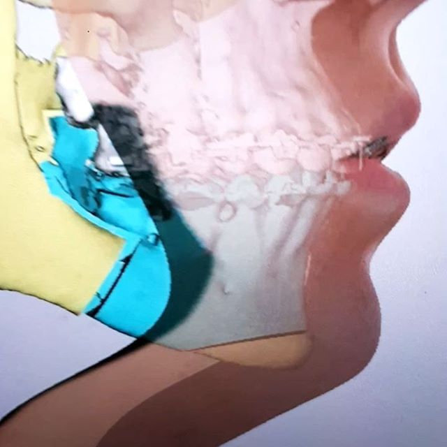 Planificación 3d en cirugía ortognática.