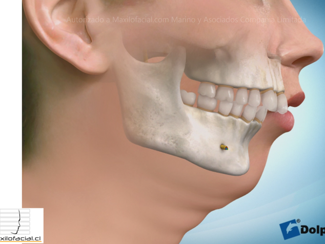 Hipoplasias mandibulares o Clases II dento facial