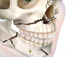 cirugia-ortognatica-1-Recuperado-Recuperado-2.jpg