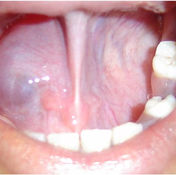 Ranula large(1).jpg