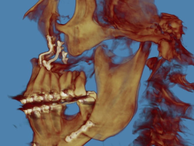 Isapres y Cirugía Ortognática - Cirugía Maxilofacial en Chile