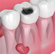 eliminacion-odontoma-quistes-dentarios-dentista-odontologo-linea-dental-ciudad-real-miguel