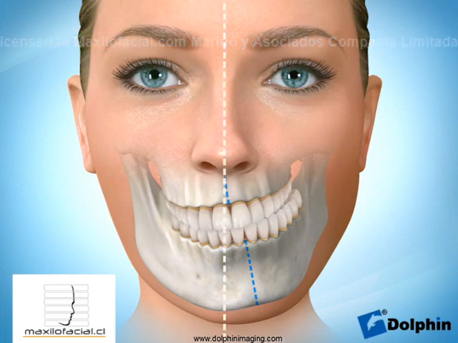 Tratamiento temprano de asimetrías faciales: causas, diagnóstico y soluciones