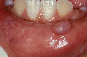 mucocele labial