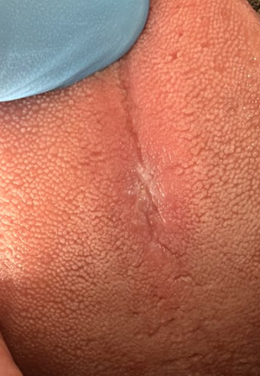 Placa blanquecina en el dorso de la lengua que no se desprende al raspado.