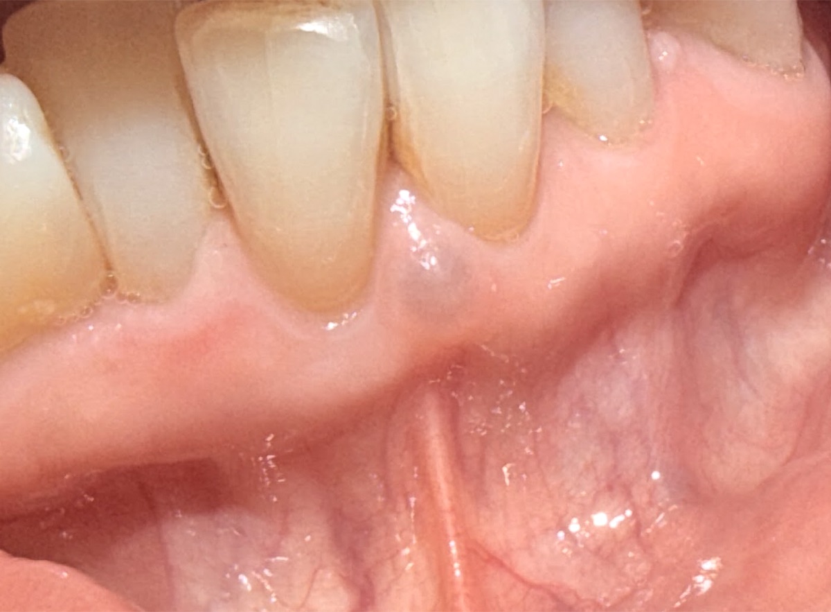 Aumento de volumen de tono azulado en la encía: el color orienta a contenido líquido o vascular.