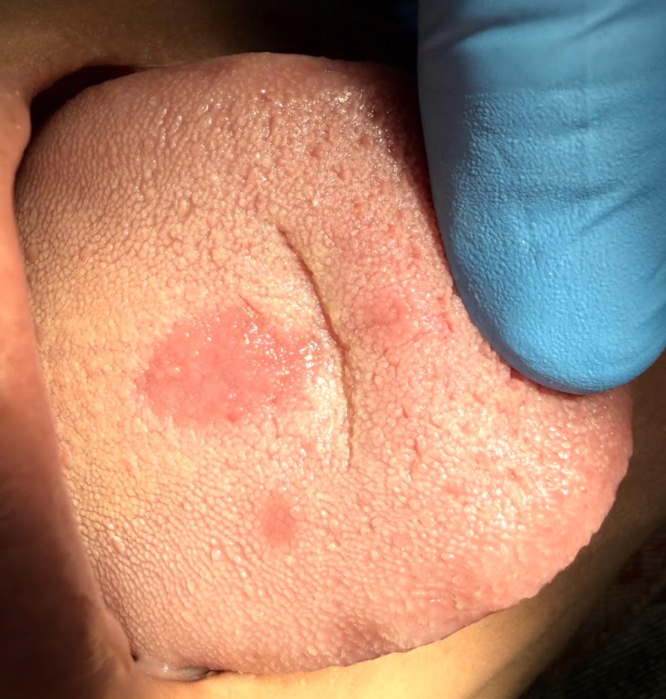 Área enrojecida bien delimitada en el dorso de la lengua, con pérdida de las papilas.
