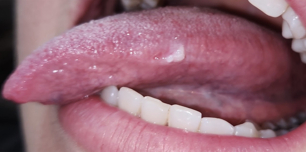 Lesión blanquecina en borde de lengua