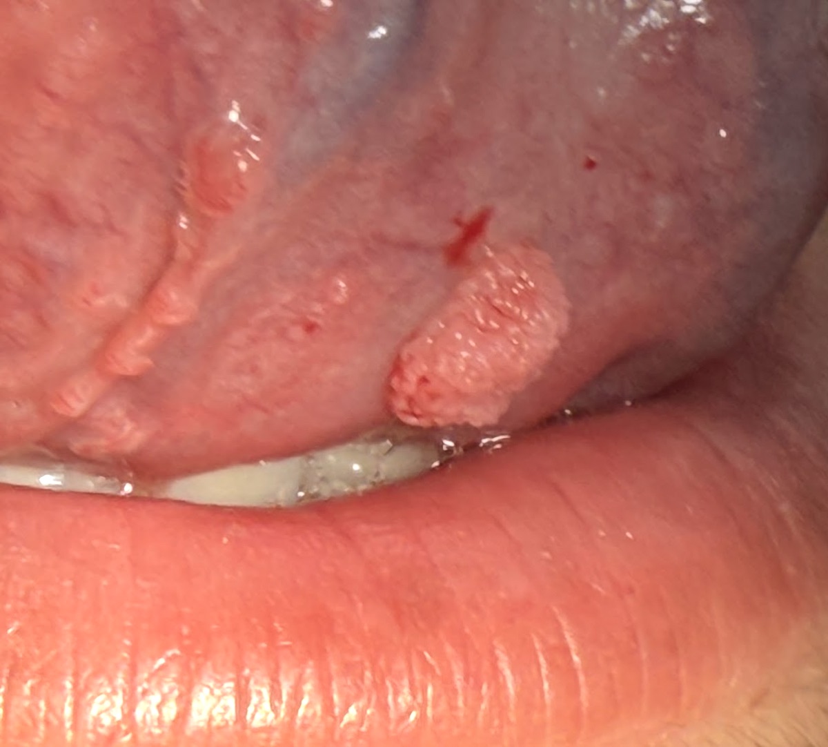 Lesión papilomatosa en mucosa labial, con proyecciones finas y aspecto de coliflor.