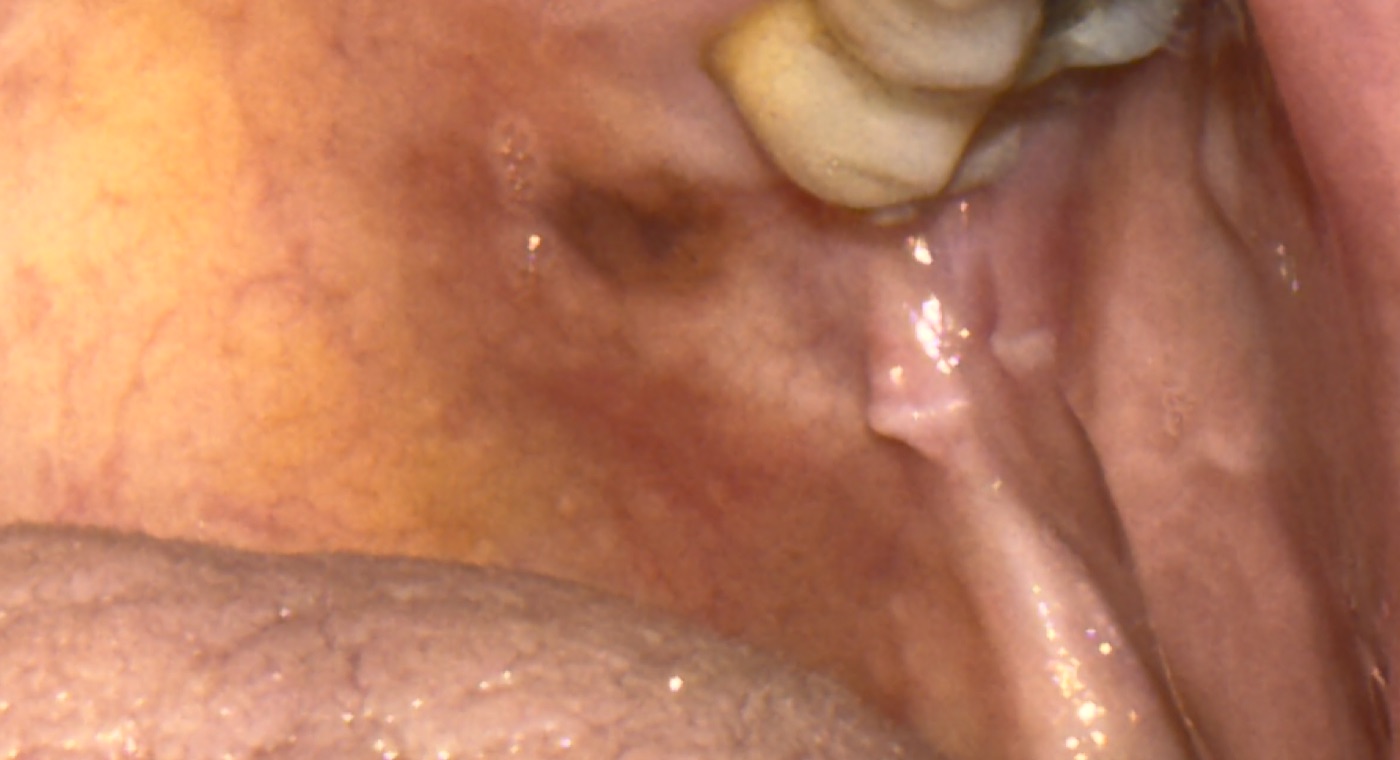 Zona de coloración parda en la mucosa oral.